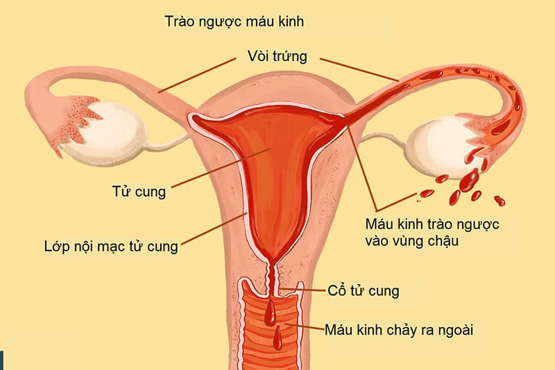 Lạc nội mạc tử cung là nguyên nhân gây giai đoạn hoàng thể ngắn