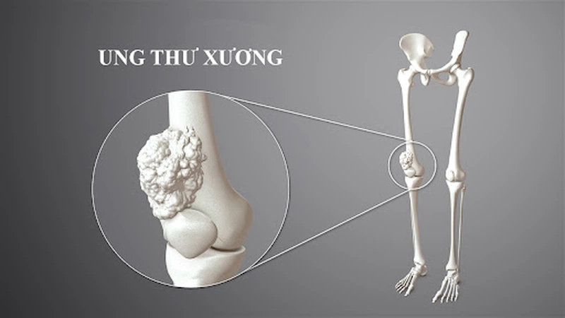 Osteosarcoma là loại sarcoma xương phổ biến nhất ở trẻ em và thanh thiếu niên.