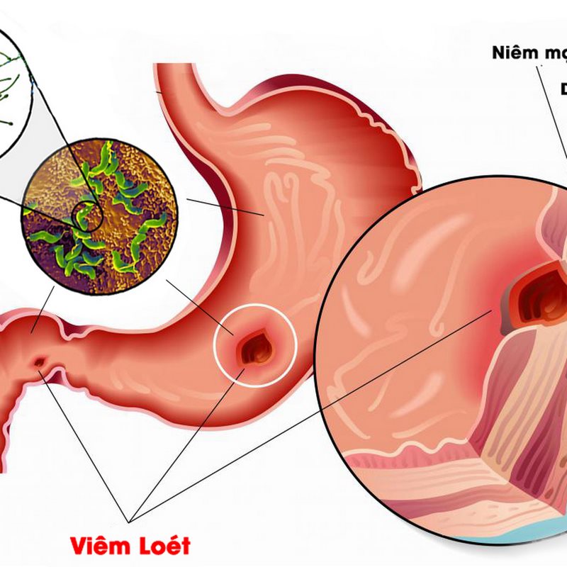 Viêm dạ dày có thể do nhiều nguyên nhân khác nhau