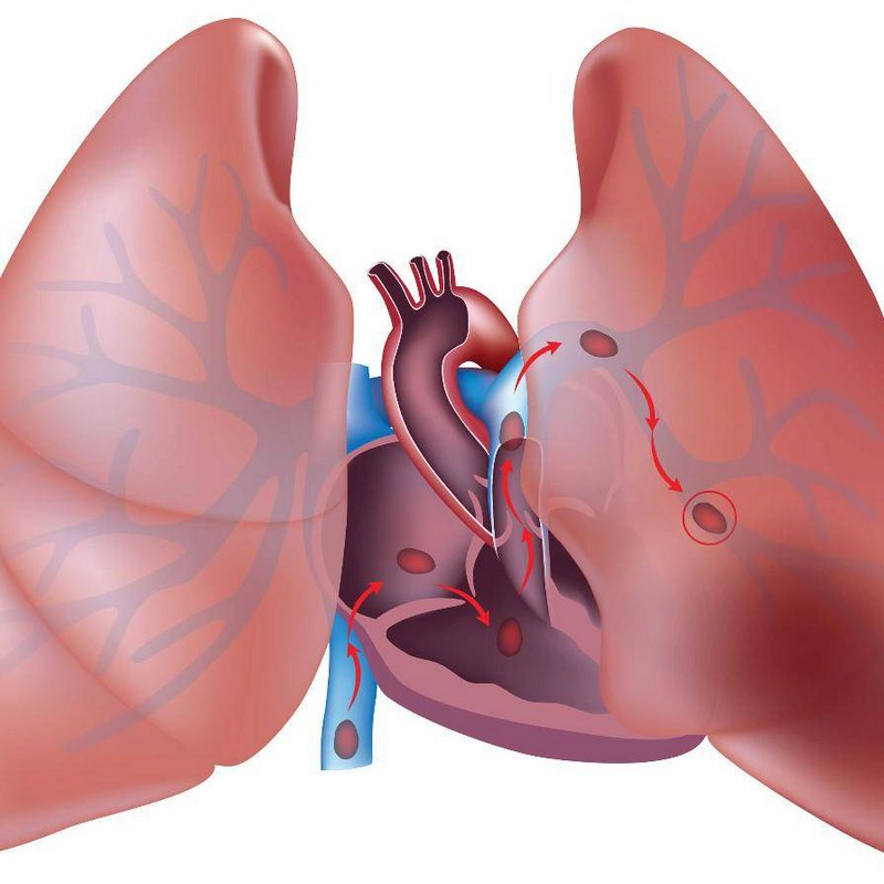 Thuyên tắc phổi thường do các cục máu đông hình thành trong tĩnh mạch sâu