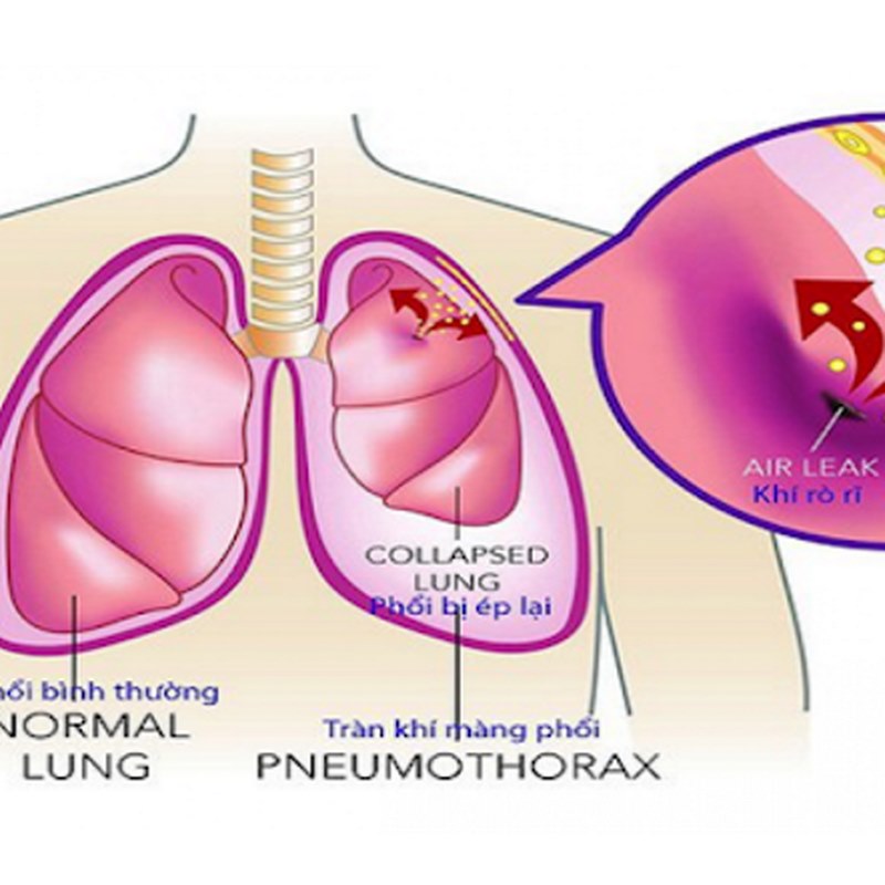 Triệu chứng của xẹp phổi phụ thuộc vào mức độ và vị trí xẹp của phổi.