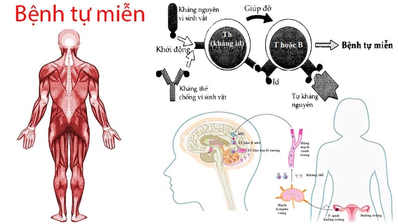 Lupus ban đỏ là một bệnh tự miễn