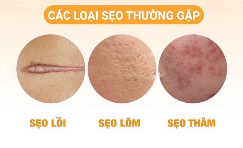 Các loại sẹo phổ biến