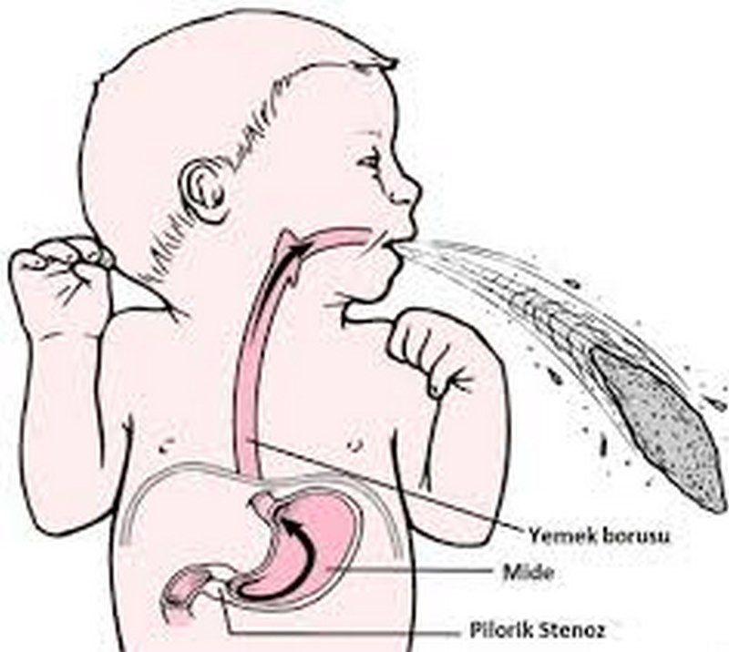 Hẹp môn vị phì đại thường biểu hiện rõ ràng qua các triệu chứng khác nhau