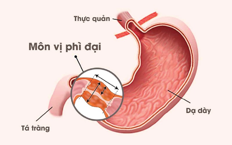 Điều trị hẹp môn vị phì đại thường đòi hỏi phải can thiệp y khoa