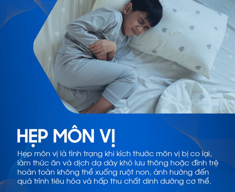 Hẹp môn vị có thể biểu hiện qua nhiều triệu chứng khác nhau