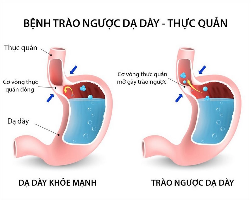 Trào ngược dạ dày là căn bệnh gây khó chịu và dễ gây biến chứng