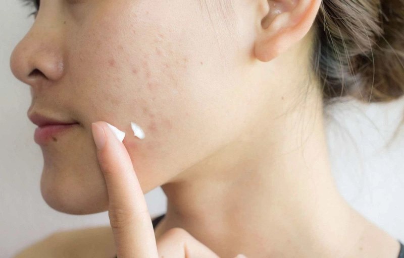Cách sử dụng Dermatix để trị sẹo thâm