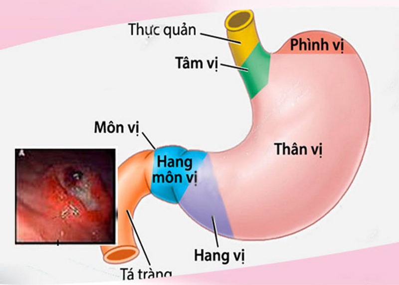 Viêm hang vị dạ dày là một dạng viêm của niêm mạc dạ dày