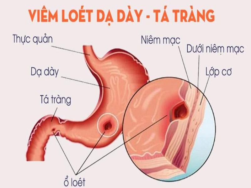 Viêm loét dạ dày - tá tràng là nguyên nhân gây ra hội chứng xuất huyết tiêu hóa trên