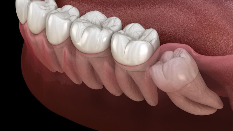 Mọc răng khôn có nên uống thuốc giảm đau không là câu hỏi được nhiều người quan tâm