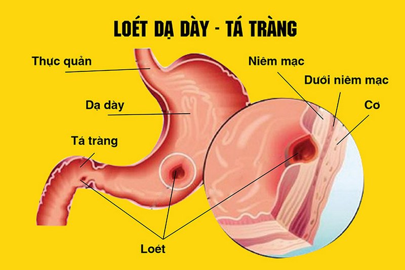 Viêm dạ dày tá tràng có thể gây ra nhiều biến chứng nguy hiểm