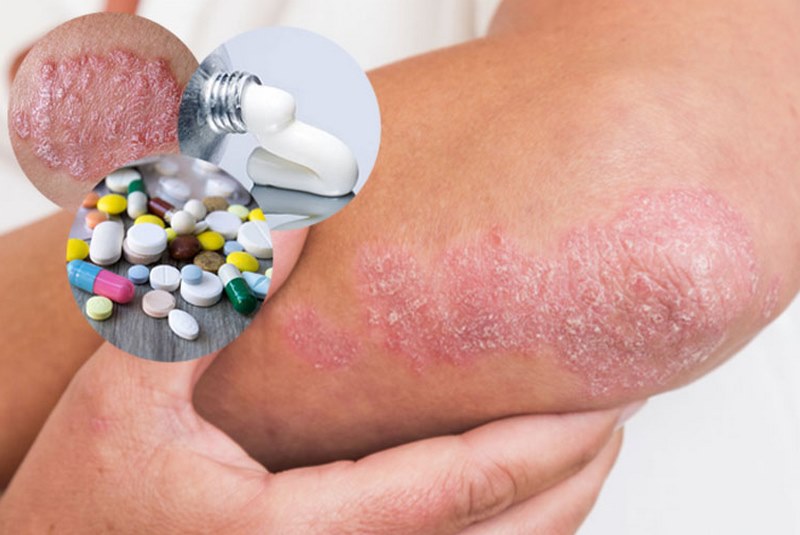 Việc điều trị bệnh vảy nến thể mủ kịp thời là rất quan trọng