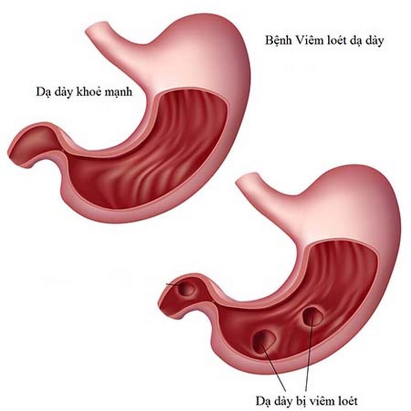 Viêm dạ dày có gây mệt mỏi không là thắc mắc của nhiều người