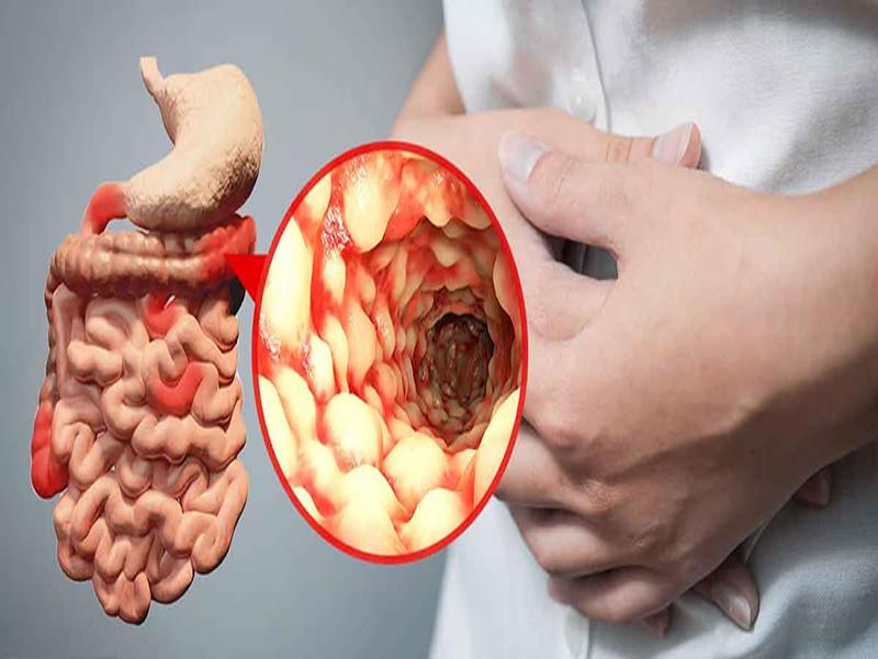 Bệnh Crohn hay còn gọi là bệnh viêm ruột mãn tính từng vùng IBD