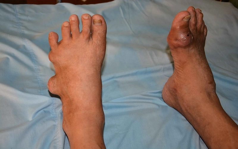 Tìm hiểu về bệnh gout là việc làm cần thiết