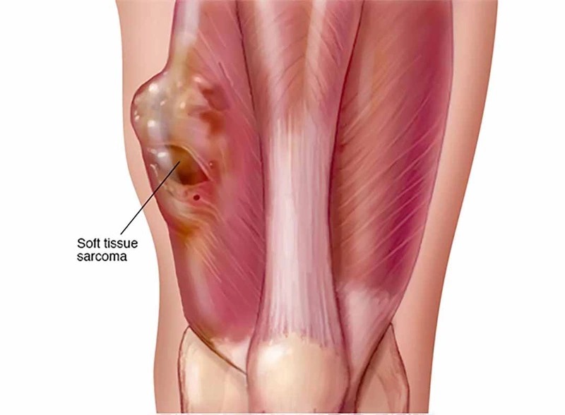 Sarcoma cơ vân là một dạng ung thư mô mềm phát sinh từ các tế bào cơ vân.