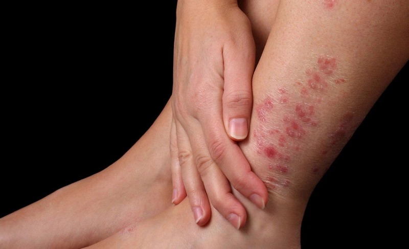 Bệnh vảy nến thể mủ là một dạng vảy nến hiếm gặp nhưng nghiêm trọng
