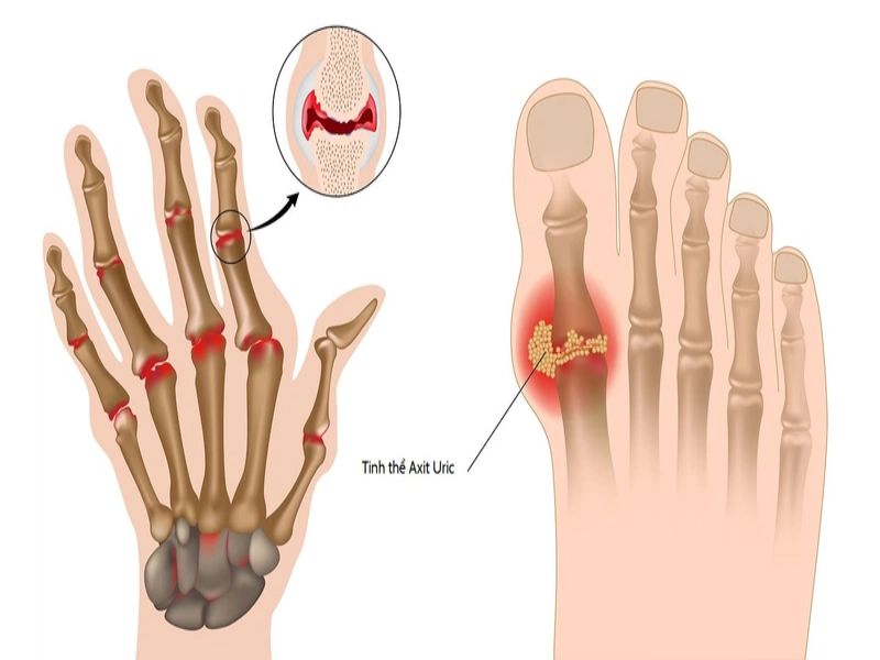 Biểu hiện gây viêm, đau khớp