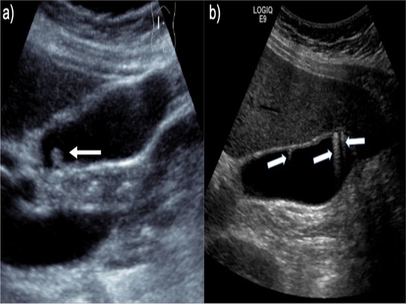 Hình ảnh siêu âm polyp túi mật