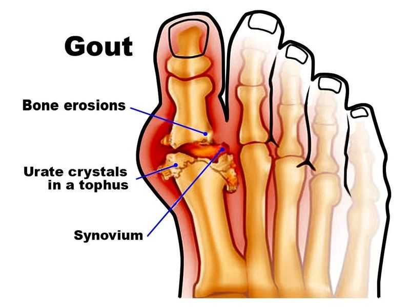 Tinh thể axit uric tích tụ trong khớp gây nên bệnh gout