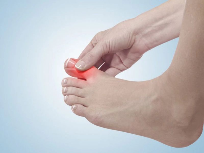 Bệnh gout gây nhiều đau đớn cho người bệnh