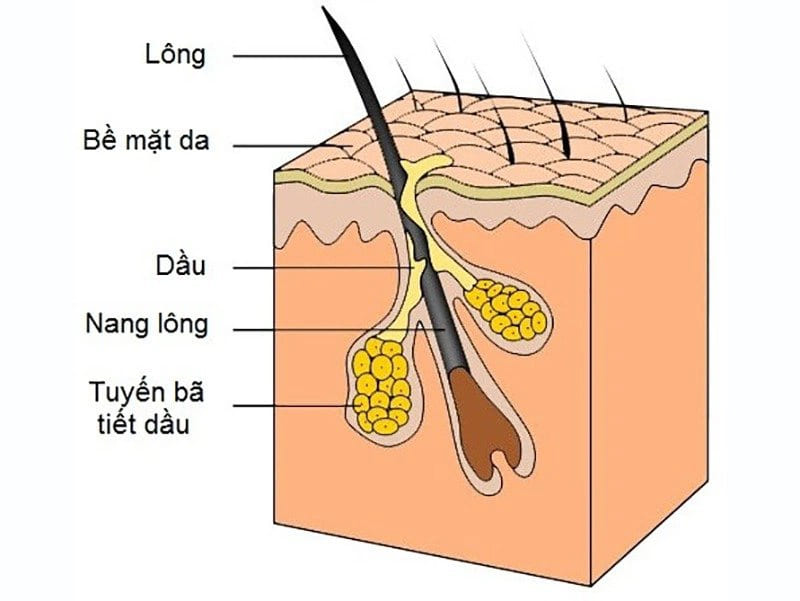 Sợi bã nhờn là các tuyến bã nhờn bị tắc nghẽn