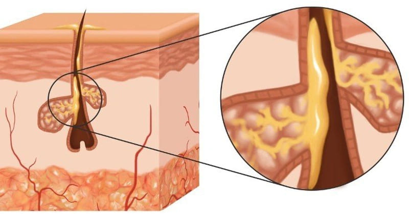 Sợi bã nhờn là các tuyến dầu nhỏ trên da mặt