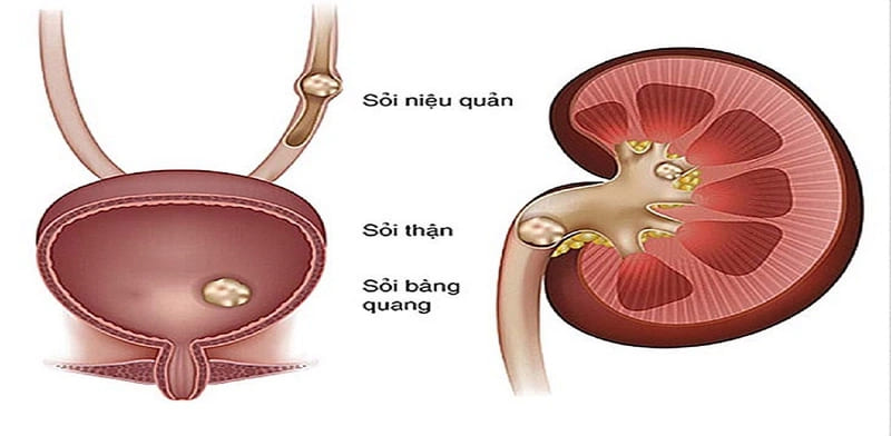 Hỗ trợ điều trị tiểu đường và phòng ngừa sỏi tiết niệu