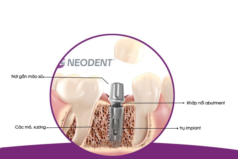 Trụ Implant Neodent, bạn sẽ không còn lo lắng về vấn đề ăn uống