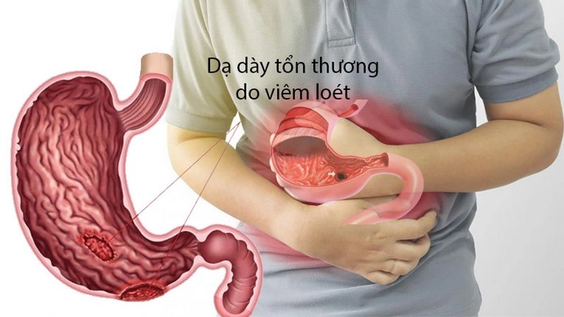 Điều trị viêm dạ dày đòi hỏi phải xác định chính xác nguyên nhân gây bệnh