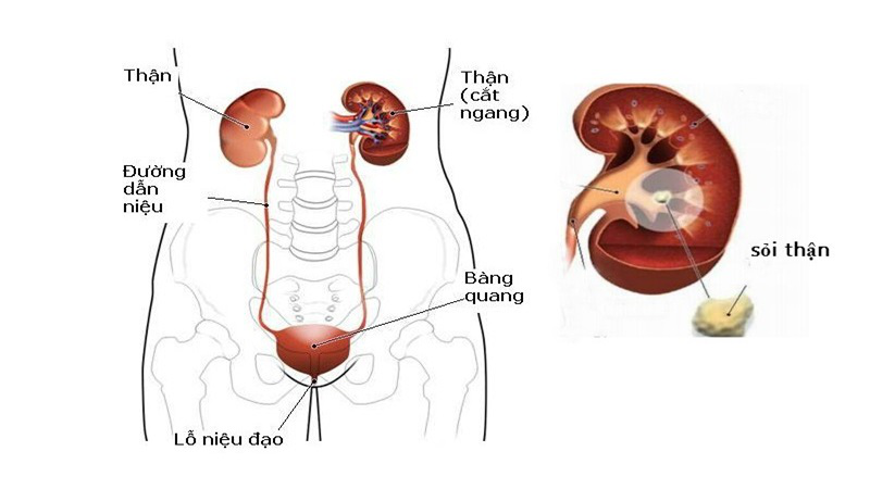 Khi bị sỏi tiết niệu phía bên trái, người bệnh thường bị đau bụng, đau thắt lưng