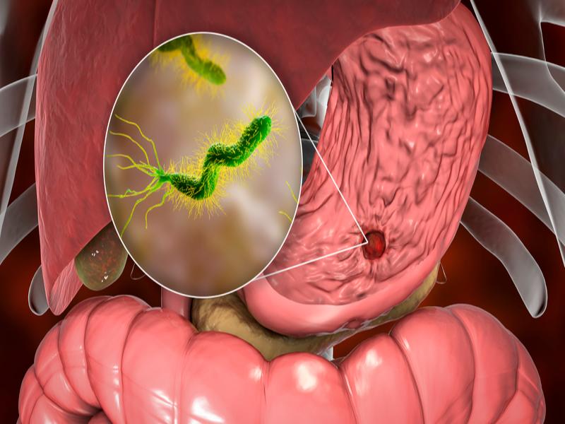 Helicobacter Pylori là một trong những nguyên nhân hàng đầu gây viêm loét dạ dày