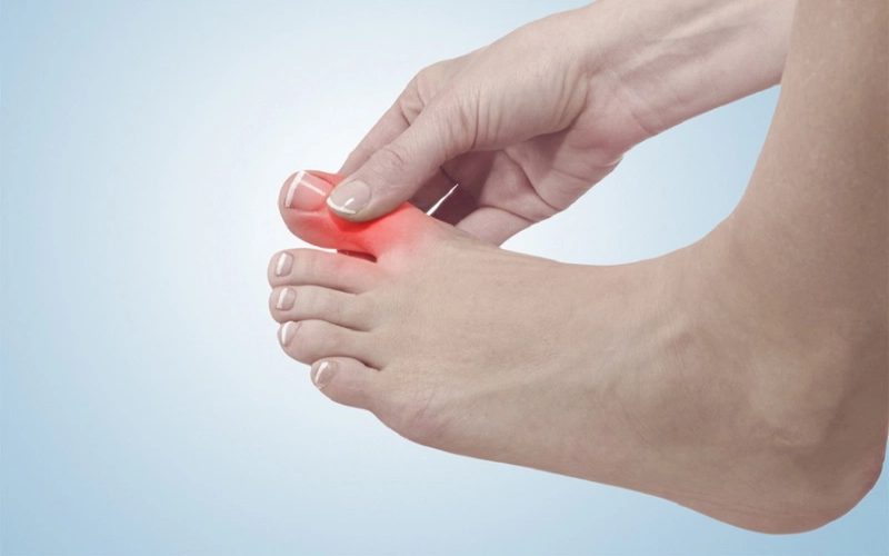 Nhiều người khổ sở vì bệnh gout hành hạ