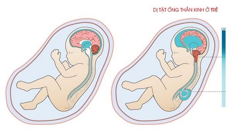 Dị tật ống thần kinh xảy ra khi ống thần kinh của thai nhi không đóng hoàn toàn