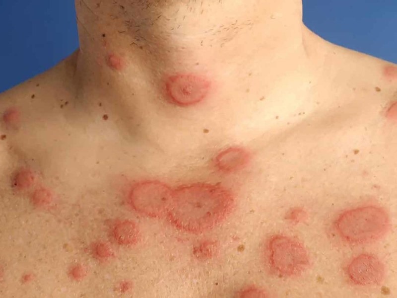 Lupus ban đỏ hệ thống (SLE) là một bệnh tự miễn mạn tính