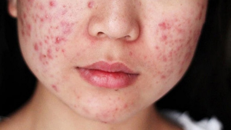 Dùng Decumar bao lâu thì hết mụn