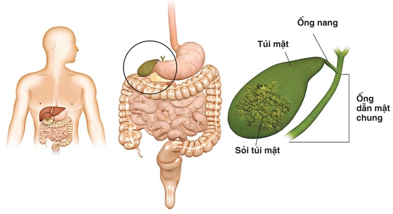 Sỏi mật là gì và triệu chứng của sỏi mật