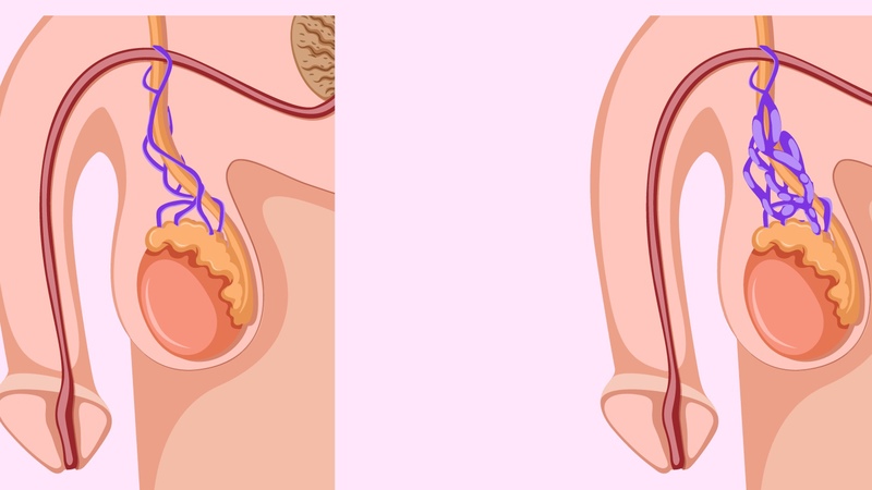 Những thực phẩm nên kiêng khi bị giãn tĩnh mạch thừng tinh