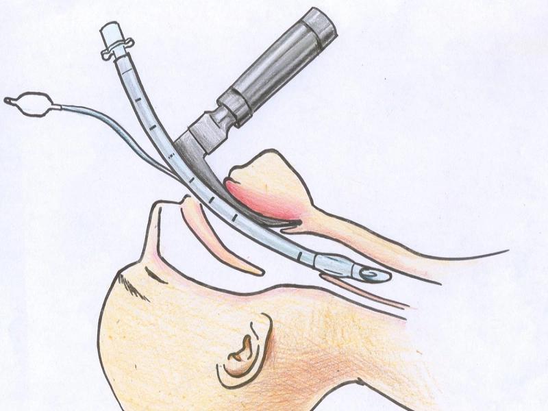 Bệnh nhân xuất huyết tiêu hóa có thể được đặt nội khí quản để tránh hít phải máu