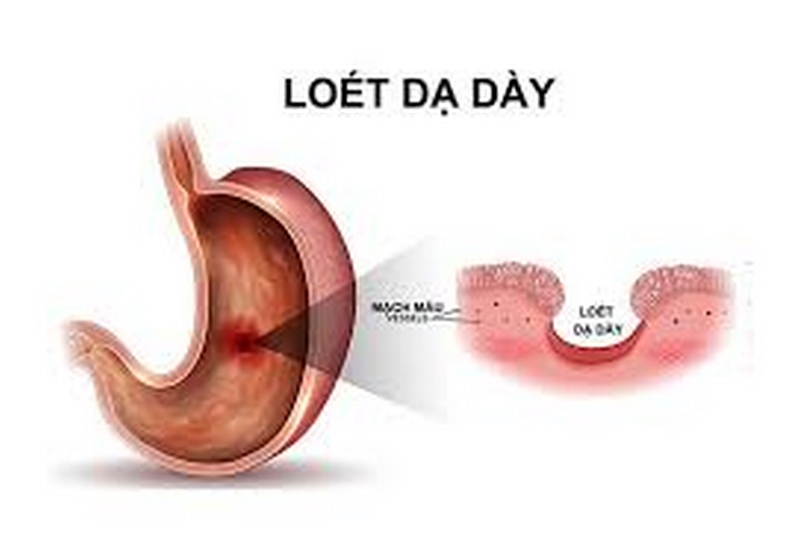 Loét dạ dày có thể gây ra các vết loét sâu vào lớp cơ của dạ dày hoặc tá tràng.