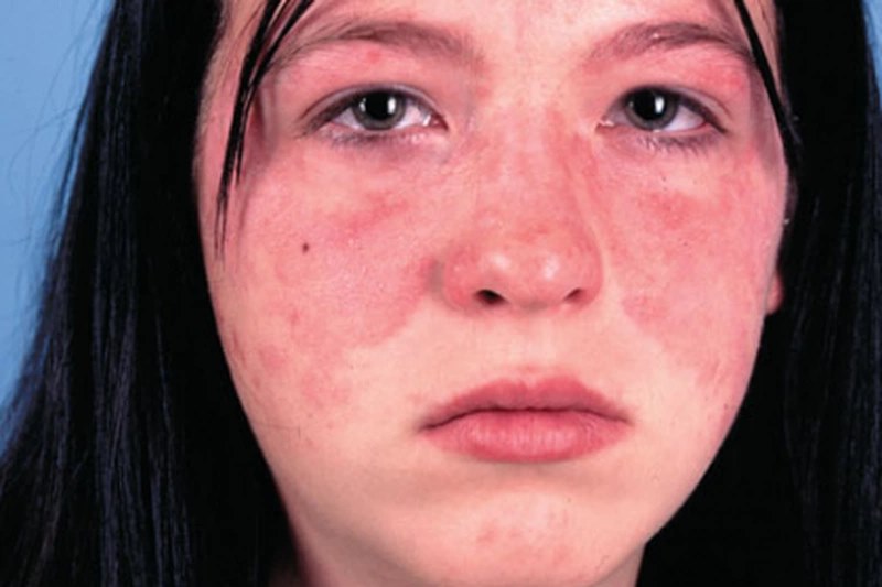 Lupus ban đỏ có nhiều triệu chứng khác nhau