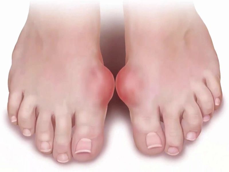 Bệnh gout hay còn gọi thống phong, là bệnh do rối loạn chuyển hóa nhân purin trong thận,