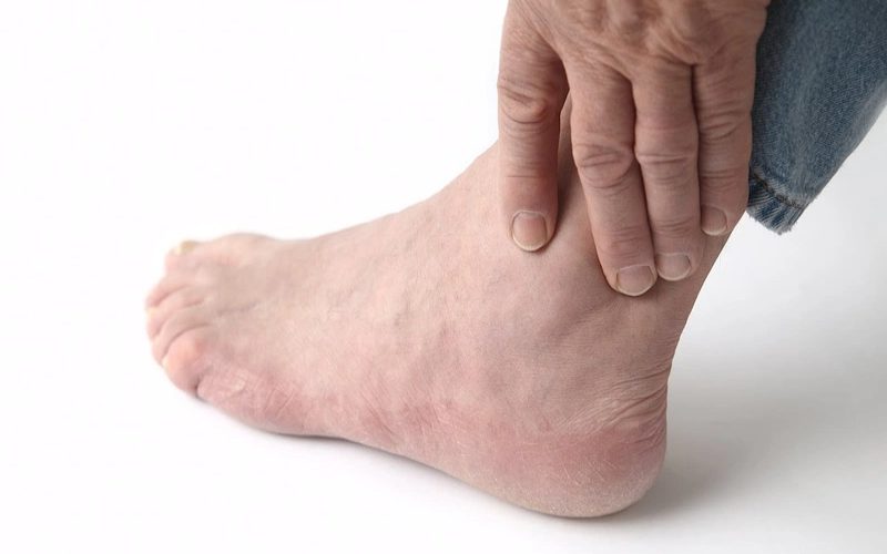 Mẹo chữa bệnh gout bằng lối sống lành mạnh