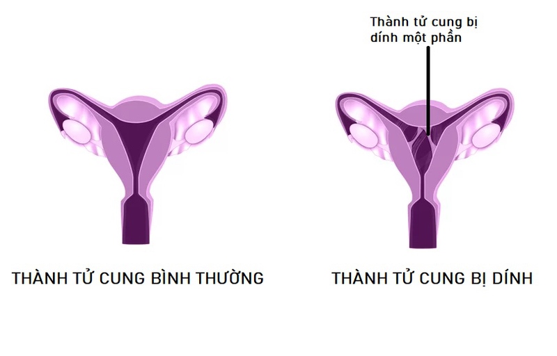 Dính buồng tử cung xảy ra khi các màng nội mạc tử cung dính vào nhau