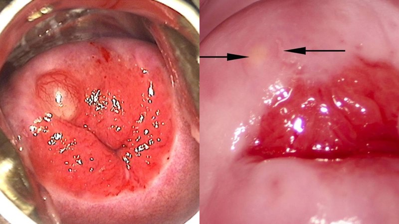 Nang Naboth là những cục mụn nhỏ trên bề mặt cổ tử cung