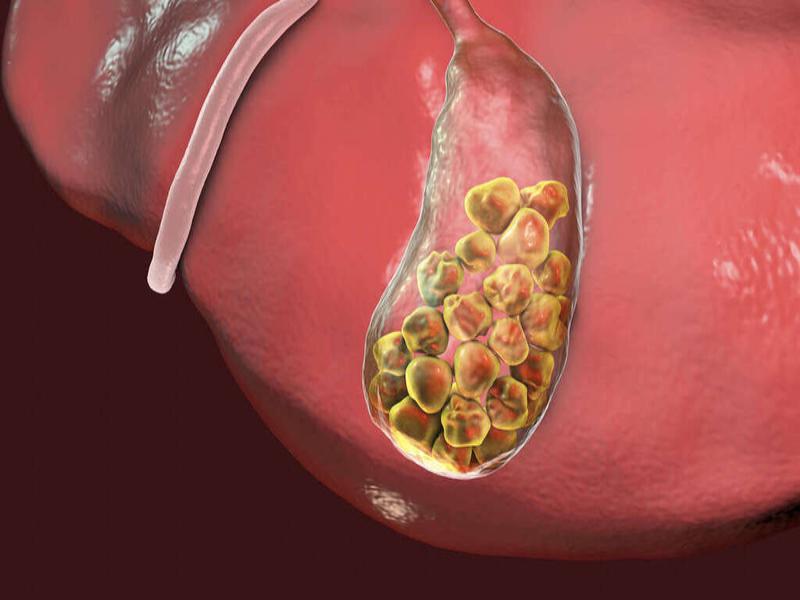 Sỏi mật hình thành 80% là sỏi cholesterol