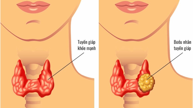 Nhân tuyến giáp là sự hình thành khối u hoặc bướu trong tuyến giáp.