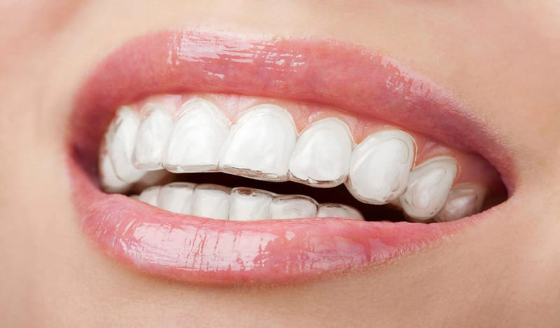 Niềng răng Clear Aligner hầu như không thể bị phát hiện khi đeo