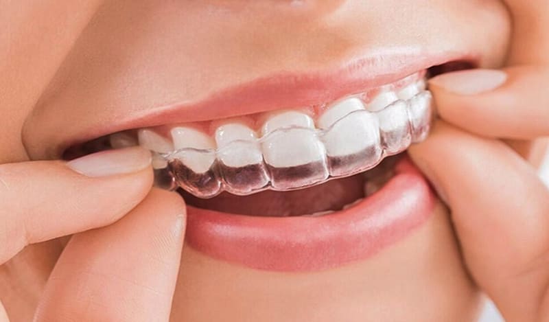 Niềng răng Clear Aligner, hay còn gọi là niềng răng trong suốt